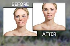 Pimple Remover Acne Remover image 3