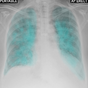 Chest X-Ray And Pathology APK