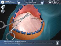 Imagine Pterional Craniotomy 10