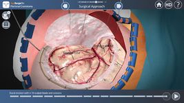 Imagine Pterional Craniotomy 