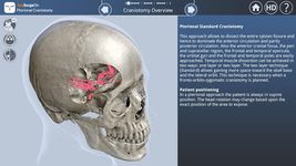 Imagine Pterional Craniotomy 1