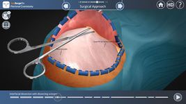 Imagine Pterional Craniotomy 5