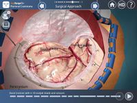 Imagine Pterional Craniotomy 6