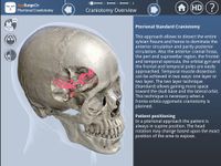 Imagine Pterional Craniotomy 7