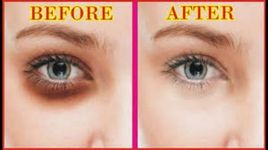 รูปภาพที่  ของ Dark Circles under the Eyes home remedies